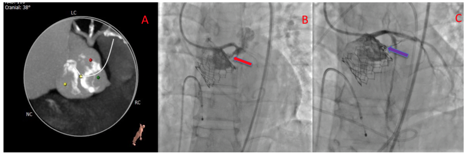 Percutaneous Approach With Coil Embolization for Annular Rupture During
